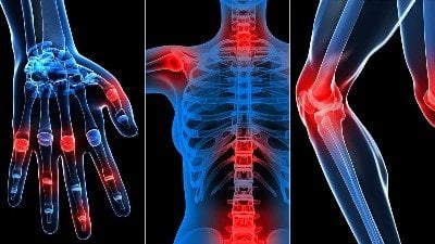 Joint Inflammation with Gout images